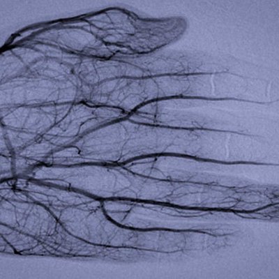 Angiography