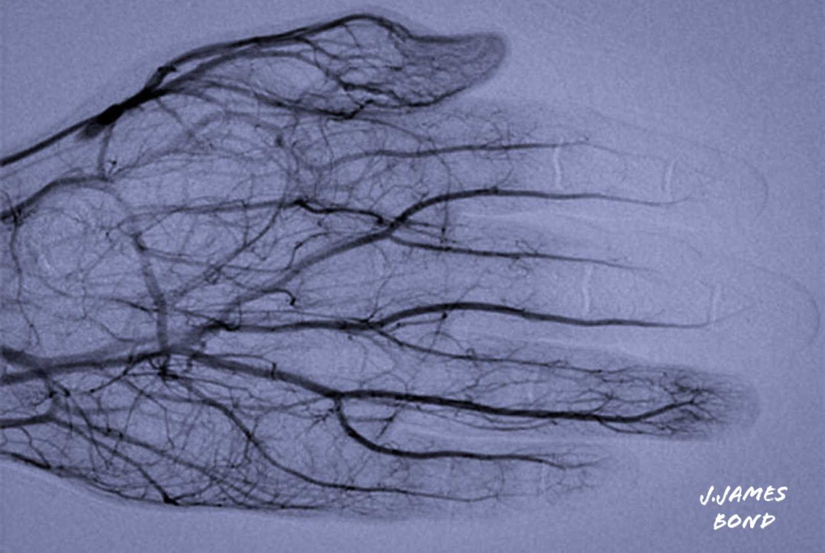 Angiography